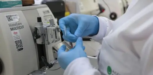 SUS passa a oferecer novo tratamento para pacientes com leucemia mieloide aguda leucemia mieloide